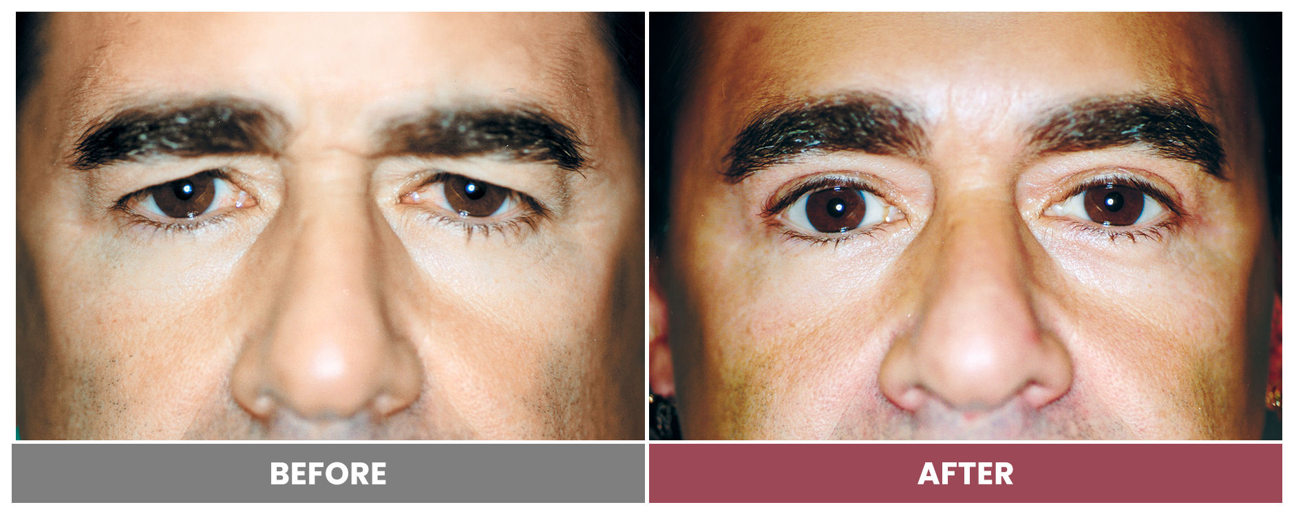 Upper Blepharoplasty - Case 76